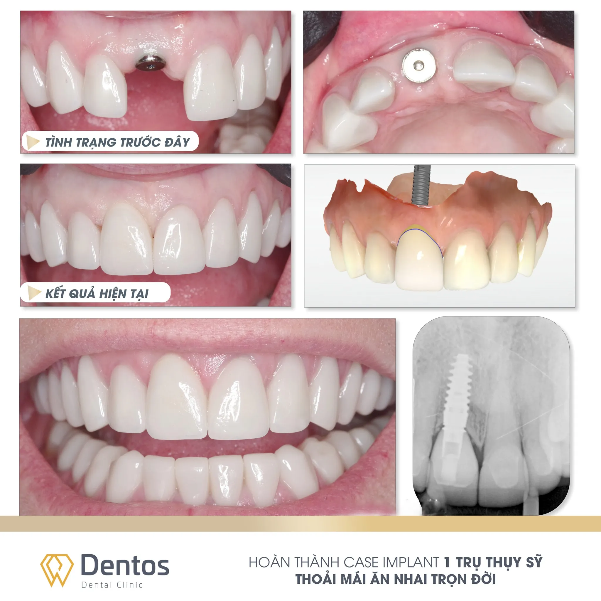 Hình ảnh hàm răng bệnh nhân trước và sau khi trồng implant